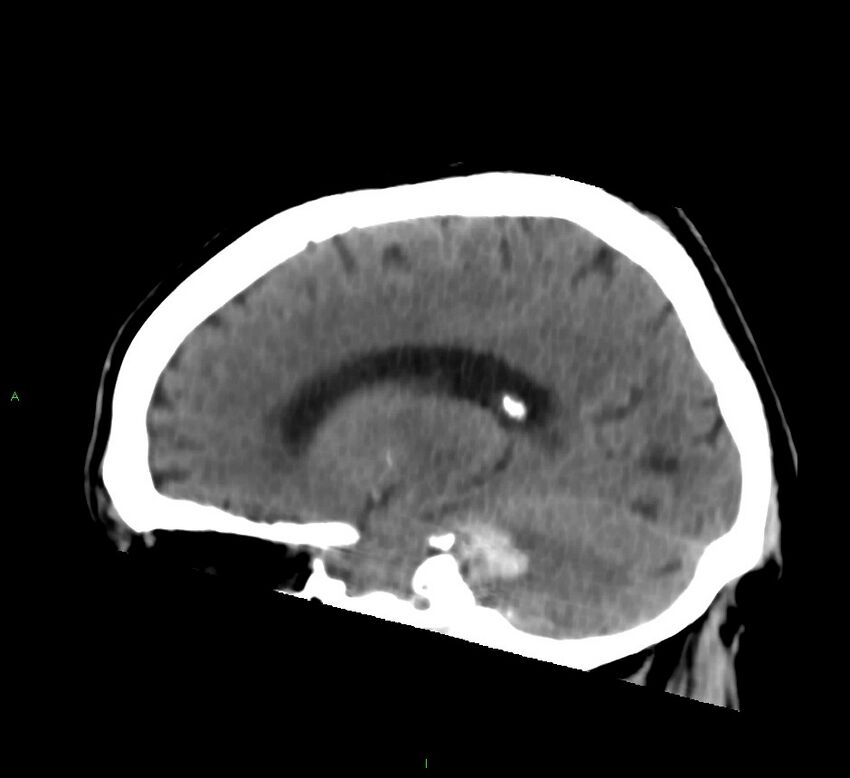 Brainstem hemorrhage (Radiopaedia 58794-66028 C 32).jpg