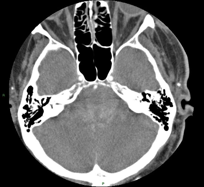 File:Brainstem hemorrhage (Radiopaedia 58794-66028 D 51).jpg
