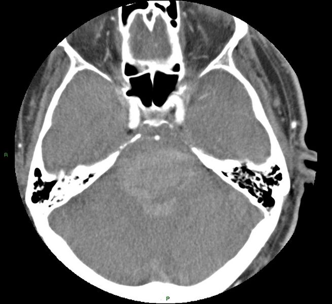 File:Brainstem hemorrhage (Radiopaedia 58794-66028 D 62).jpg