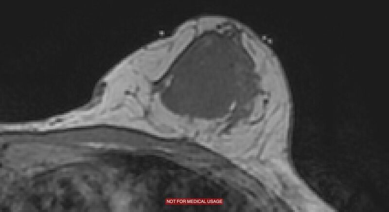 File:Breast lymphoma (MRI) (Radiopaedia 34999-36498 Axial T1 5).jpg