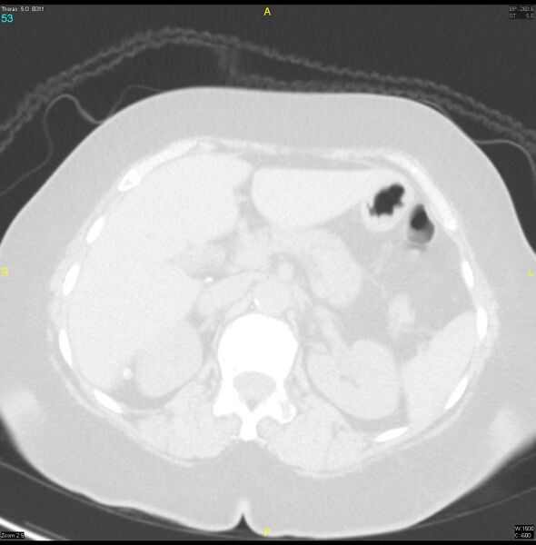 File:Breast primary with lung and bone metastases (Radiopaedia 40620-43228 Axial lung window 53).jpg