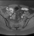 Broad ligament leiomyoma (Radiopaedia 81634-95516 Axial T1 fat sat 5).jpg