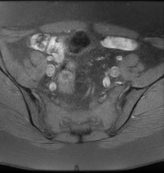 File:Broad ligament leiomyoma (Radiopaedia 81634-95516 Axial T1 fat sat 5).jpg