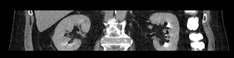 File:Buried bumper syndrome - gastrostomy tube (Radiopaedia 63843-72575 Coronal Inject 60).jpg