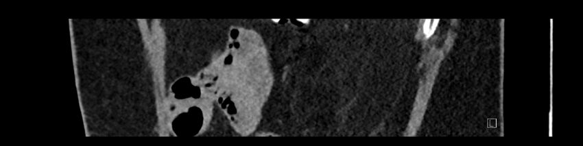 Buried bumper syndrome - gastrostomy tube (Radiopaedia 63843-72575 Sagittal Inject 21).jpg