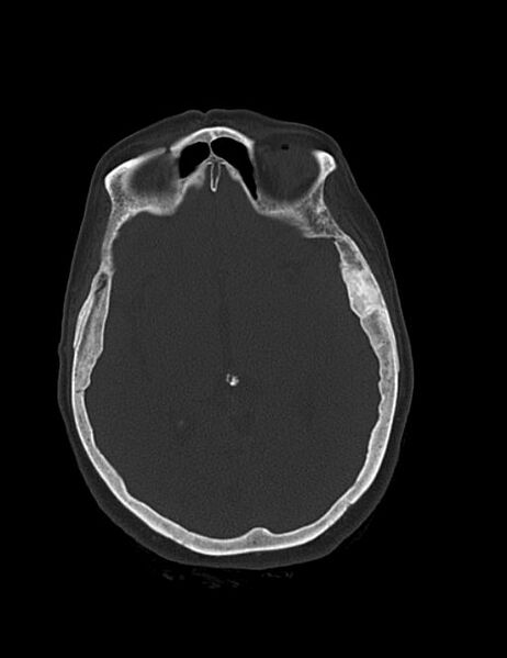 File:Burnt-out meningioma (Radiopaedia 51557-57337 Axial bone window 23).jpg