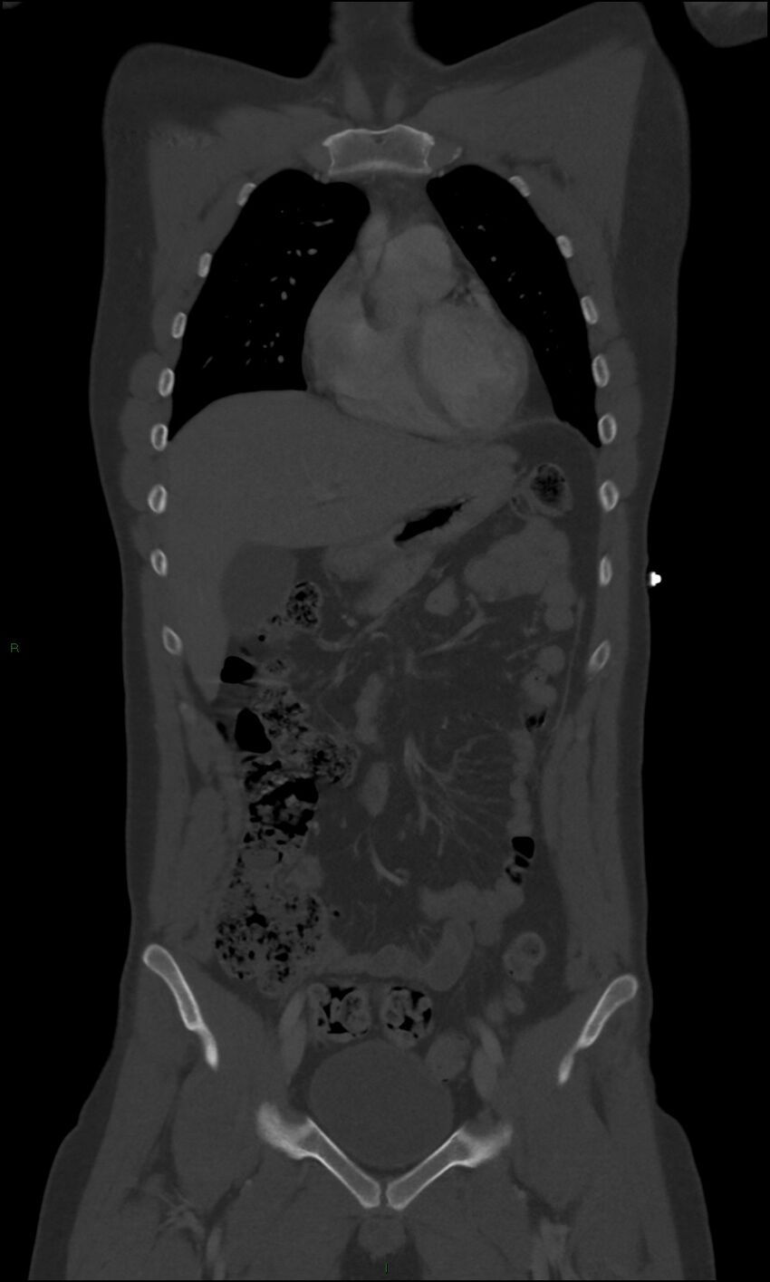 Burst fracture (Radiopaedia 83168-97542 Coronal bone window 25).jpg