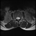 Burst fracture - lumbar spine (Radiopaedia 72877-83541 Axial T2 5).jpg