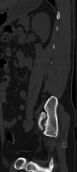 File:Calcaneal fractures with associated L2 burst fracture (Radiopaedia 71671-82493 Sagittal bone window 4).jpg