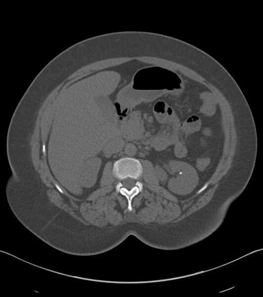 File:Calcified hepatic hydatid cyst (Radiopaedia 81127-94738 Axial non-contrast 38).jpg