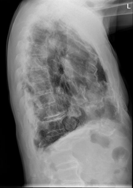 File:Calcified pleural plaques (Radiopaedia 24792-25055 Lateral 1).jpg