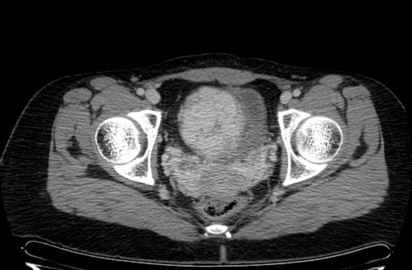 Cannonball metastases - uterine choriocarcinoma (Radiopaedia 70137-80174 A 43).jpg