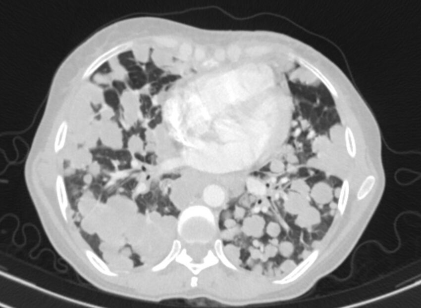 Cannonball metastases from breast cancer (Radiopaedia 91024-108569 Axial lung window 61).jpg