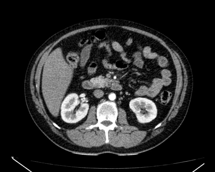 Carcinoid tumor with hepatic metastases (Radiopaedia 22651-22670 B 38).jpg