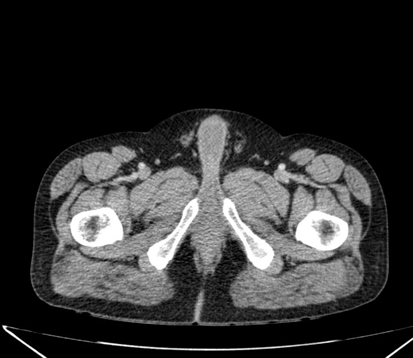 Carcinoid tumor with hepatic metastases (Radiopaedia 22651-22670 C 82).jpg