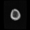 Caroticocavernous fistula (Radiopaedia 8617-9440 Axial T1 22).jpg
