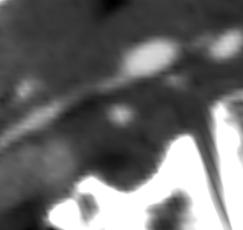 Carotid near-occlusion (Radiopaedia 85304-100887 M 105).jpg