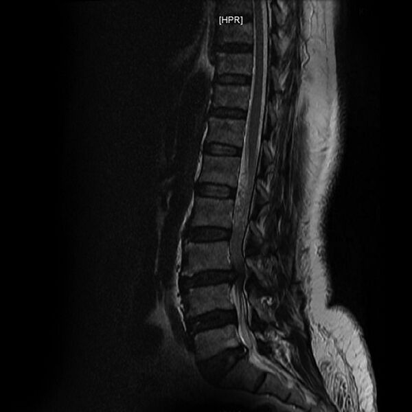 File:Cauda equina syndrome from lumbar disc bulge (Radiopaedia 6754-7954 Sagittal T2 1).jpg
