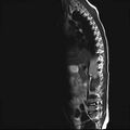 Caudal regression syndrome (Radiopaedia 61990-70072 Sagittal T2 1).jpg