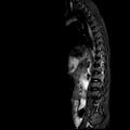 Caudal regression syndrome (Radiopaedia 61990-70072 Sagittal T2 TIRM 8).jpg