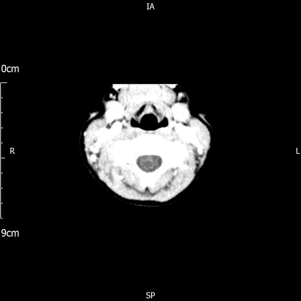 File:Cavernous sinus thrombosis (Radiopaedia 79414-92510 Axial Brain 7).jpg