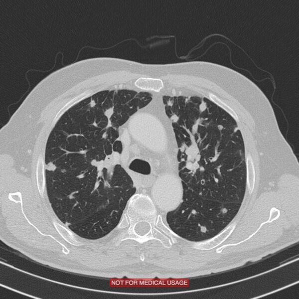 File:Cavitating pulmonary metastases (Radiopaedia 24920-25184 Axial lung window 7).jpg
