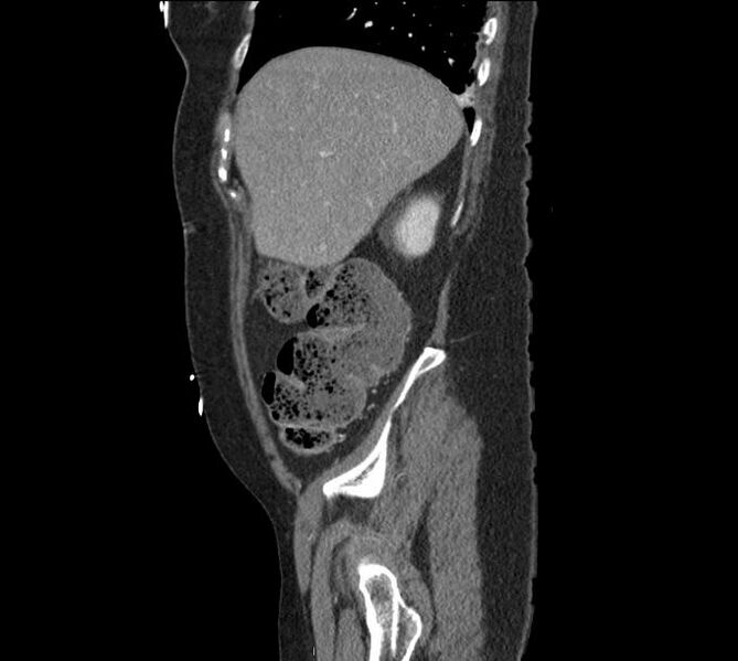 File:Celiac artery severe stenosis and dissection (Radiopaedia 44128-47842 A 31).jpg