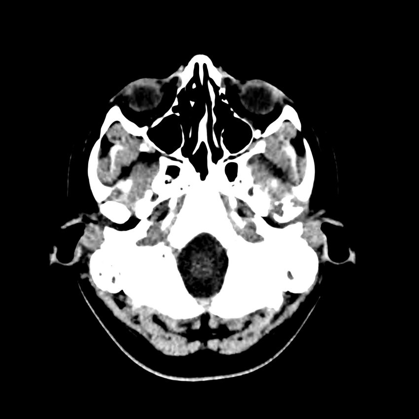 Central nervous system Langerhans cell histiocytosis (Radiopaedia 65728-74878 Axial non-contrast 9).jpg