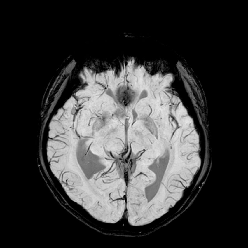 Central neurocytoma (Radiopaedia 79320-92380 Axial SWI 62).jpg