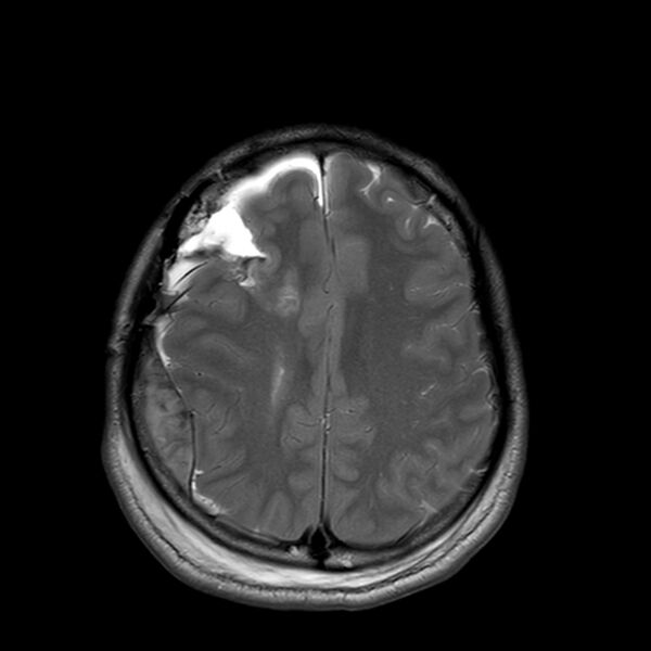 File:Central neurocytoma (Radiopaedia 79320-92381 Axial T2 20).jpg