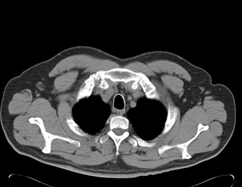 File:Centrilobular pulmonary emphysema (Radiopaedia 26808-26971 Axial non-contrast 4).jpg