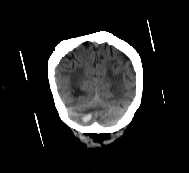 File:Cerebellar hemorrhage (Radiopaedia 58792-66026 Coronal non-contrast 17).jpg