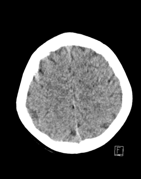File:Cerebellar stroke (Radiopaedia 32202-33149 Axial non-contrast 24).png