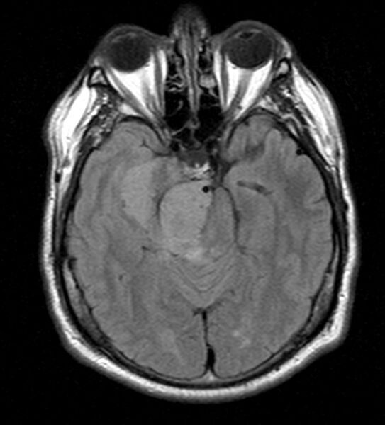 File:Cerebellopontine angle meningioma (Radiopaedia 24459-24764 Axial FLAIR 9).jpg
