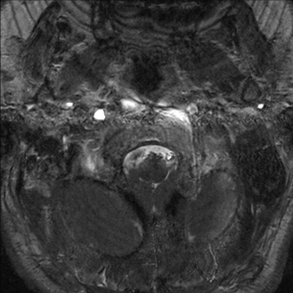 File:Cerebellopontine angle meningioma (Radiopaedia 24459-24764 I 1).jpg
