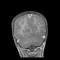 Cerebral abscess post cardiac surgery (Radiopaedia 27244-27420 Coronal T1 C+ 18).jpg