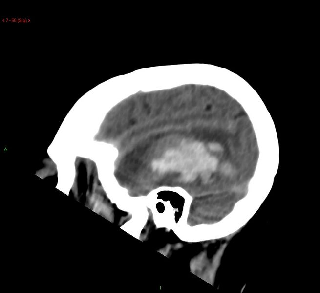 File:Cerebral amyloid angiopathy-associated lobar intracerebral hemorrhage (Radiopaedia 58378-65518 C 50).jpg