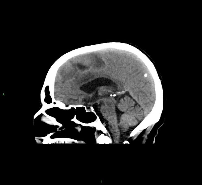File:Cerebral amyloid angiopathy-associated lobar intracerebral hemorrhage (Radiopaedia 58529-65681 B 25).jpg
