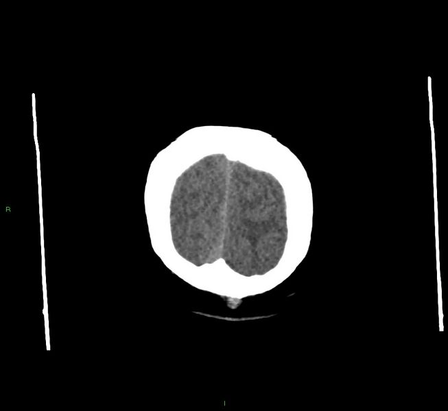 File:Cerebral amyloid angiopathy-associated lobar intracerebral hemorrhage (Radiopaedia 58560-65723 Coronal non-contrast 8).jpg