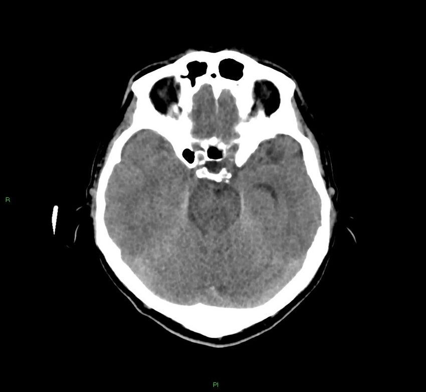 Cerebral amyloid angiopathy-associated lobar intracerebral hemorrhage (Radiopaedia 58756-65977 Axial non-contrast 35).jpg