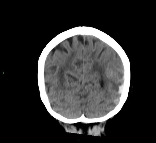 File:Cerebral amyloid angiopathy-associated lobar intracerebral hemorrhage (Radiopaedia 58757-65978 Coronal non-contrast 19).jpg