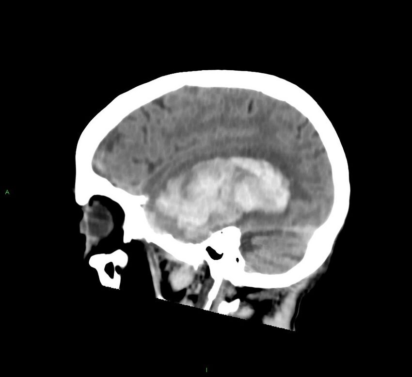 Cerebral amyloid angiopathy-associated lobar intracerebral hemorrhage (Radiopaedia 58758-65980 C 15).jpg
