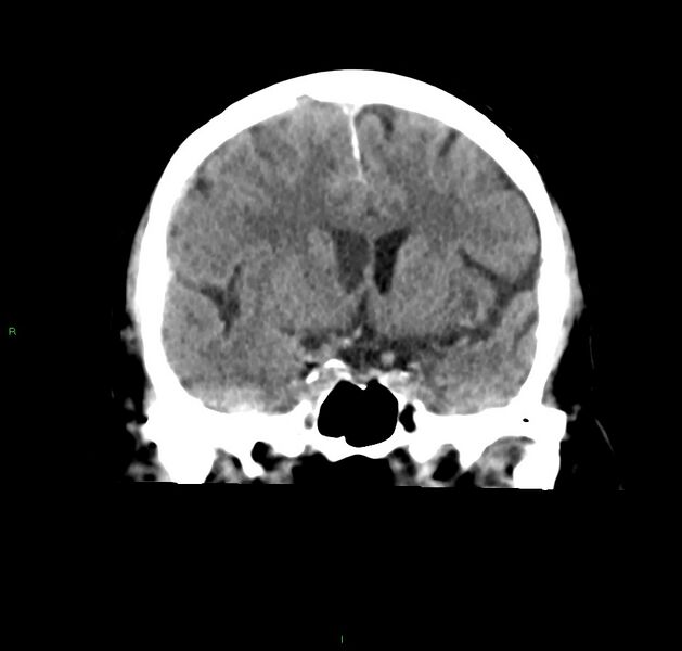 File:Cerebral amyloid angiopathy-associated lobar intracerebral hemorrhage (Radiopaedia 59356-66716 Coronal non-contrast 40).jpg