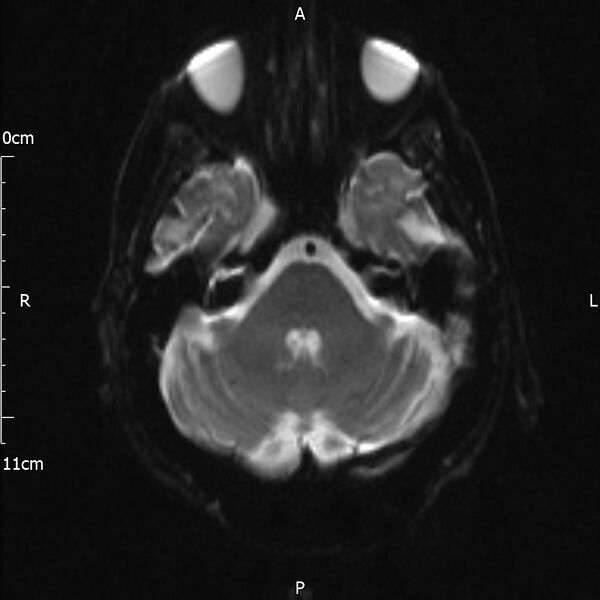 File:Cerebral amyloid angiopathy related inflammation (Radiopaedia 72772-83415 Axial DWI 7).jpg