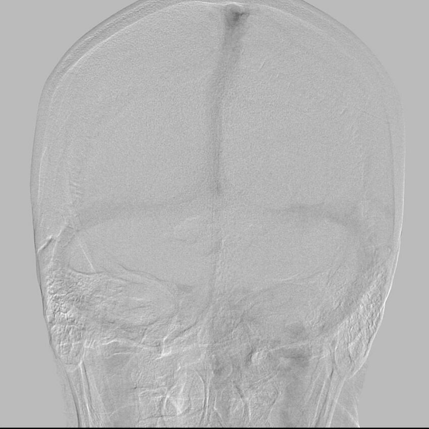 Cerebral aneurysm with rupture (Radiopaedia 29933-30458 LT CCA IC 25).jpg
