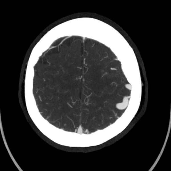 File:Cerebral arteriovenous malformation (Radiopaedia 43729-47189 B 40).jpg