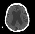 Cerebral atrophy (Radiopaedia 11287-11651 C 1).jpg