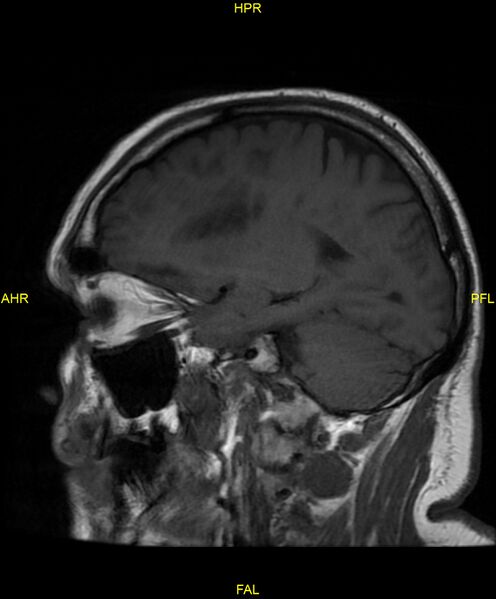 File:Cerebral autosomal dominant arteriopathy with subcortical infarcts and leukoencephalopathy (CADASIL) (Radiopaedia 86108-102054 Sagittal T1 18).jpg