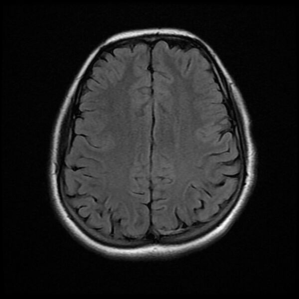 File:Cerebral cavernous malformation (Radiopaedia 44301-47942 Axial FLAIR 15).jpg