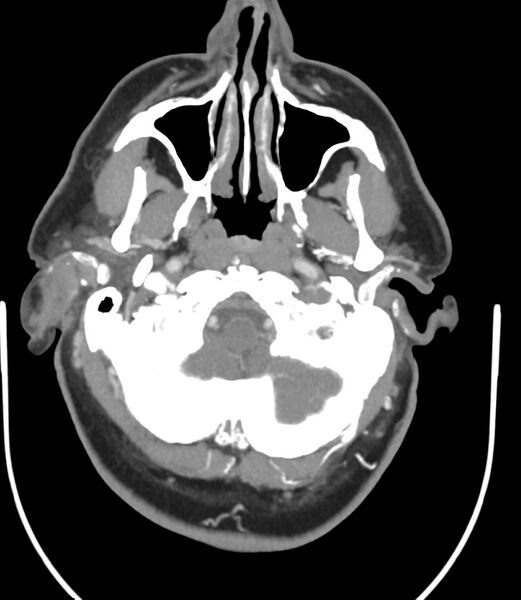 File:Cerebral dural venous sinus thrombosis (Radiopaedia 86514-102576 A 25).jpg